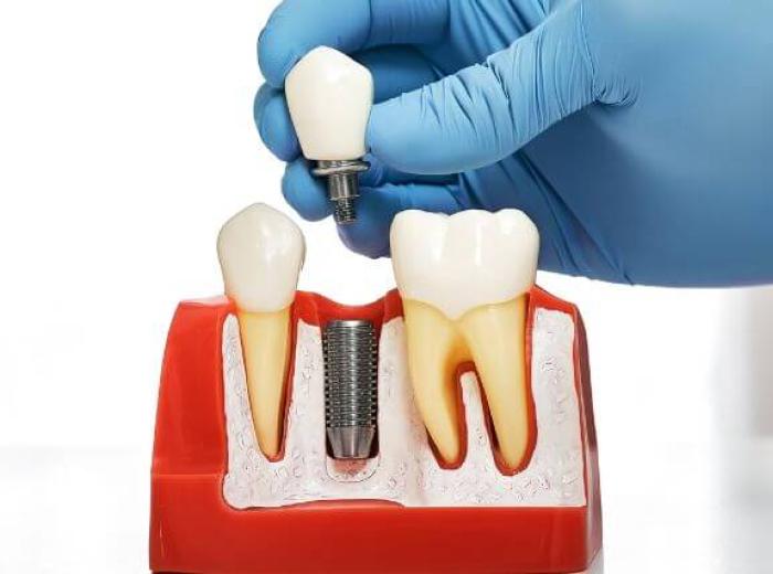 Dental Implants 101: How Your Jawbone Supports a New Tooth